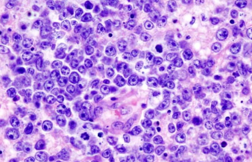 картинка лимфомы